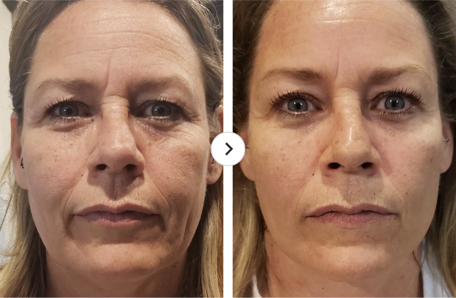 'Before and after comparison of a woman's facial features, possibly showing the results of a skincare treatment.'